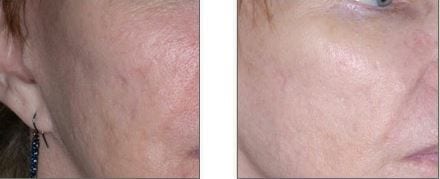 Best Laser Treatment For Acne Scars: Laser Acne Scar Removal