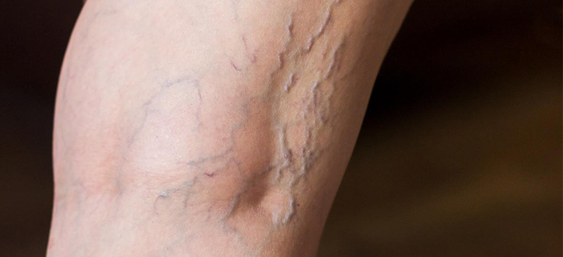 Are Varicose Veins Dangerous?