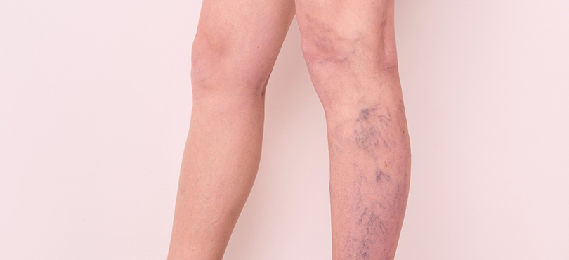 How to Hide Bulging Varicose Veins