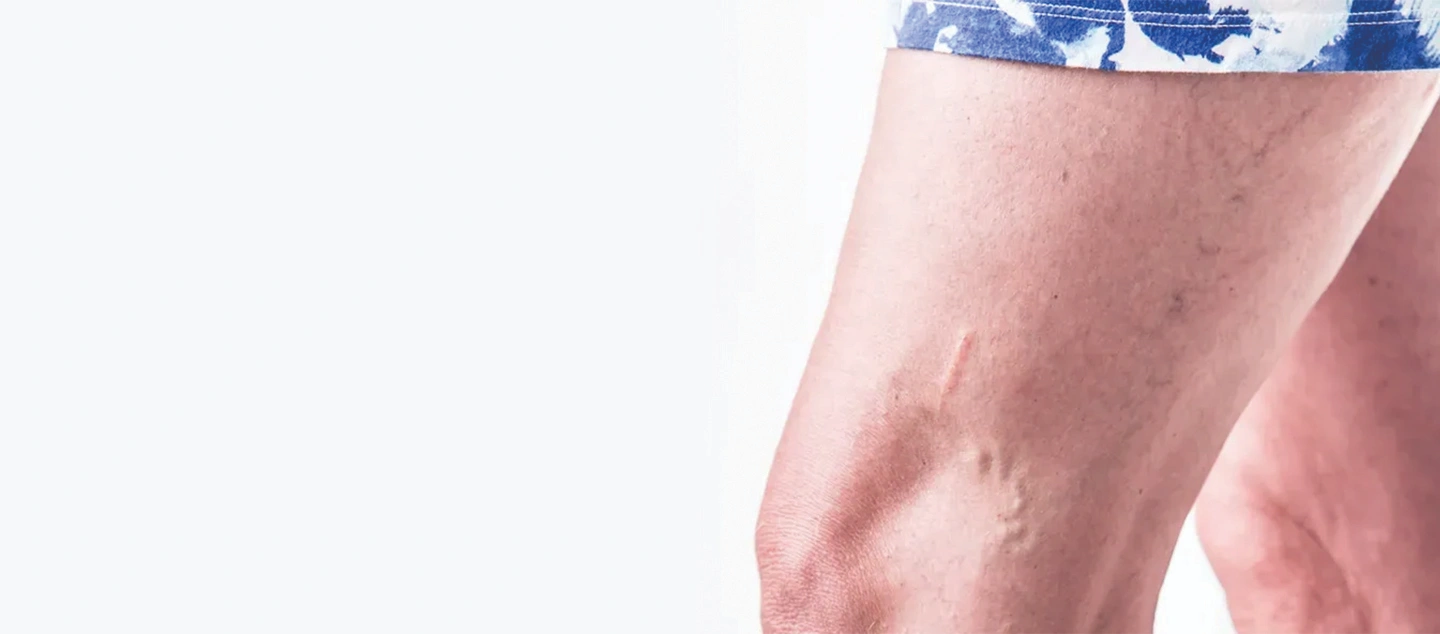 How To Get Rid of Spider Veins and Varicose Veins