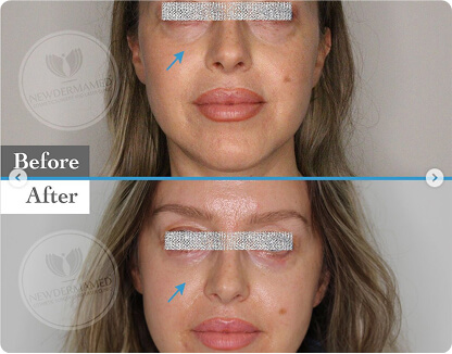 Dermal Filler Injection
