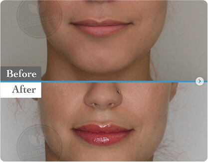 Dermal Filler Injection