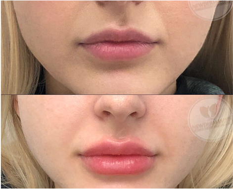 Dermal Filler Injection