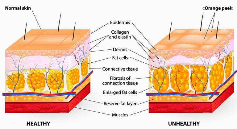 What Causes Cellulite?