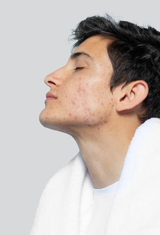 Laser Acne Treatment