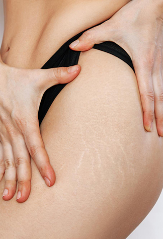 Stretch Mark Treatment