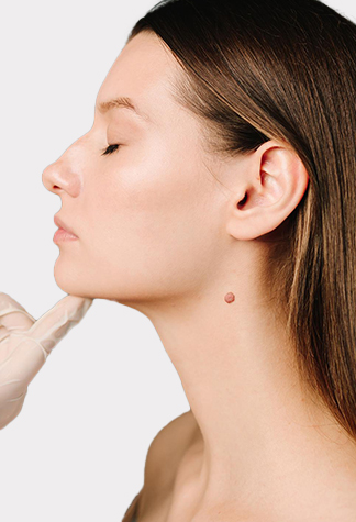 Mole Removal