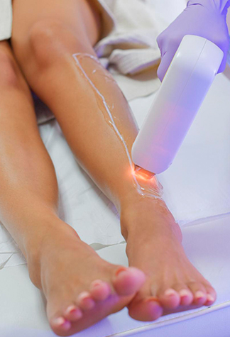 Laser Vein Removal