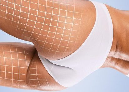 BBL Liquid Butt Lift – Non-Surgical Butt Enhancement