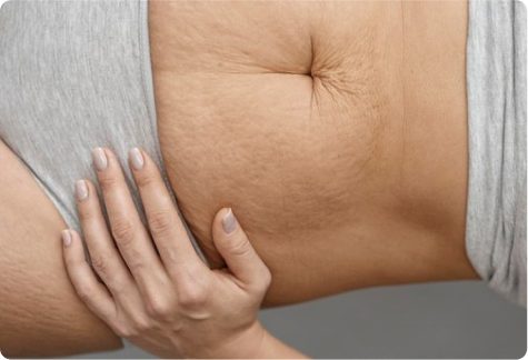 Laser Scar Removal