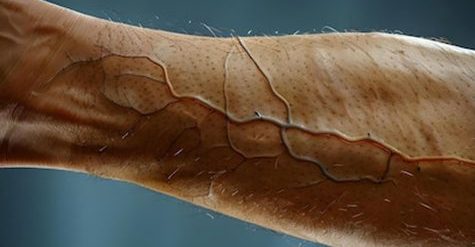 Sclerotherapy