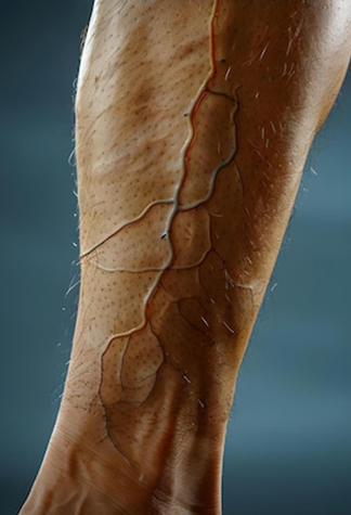Sclerotherapy