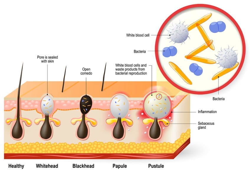 Types of Acne