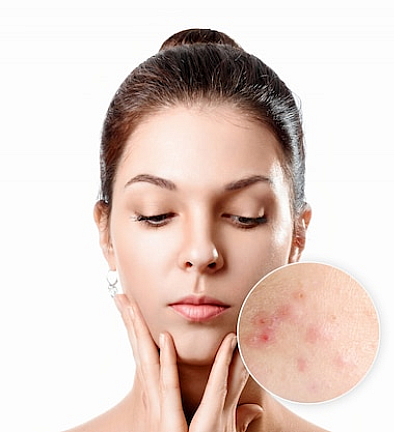 Acne Clinic