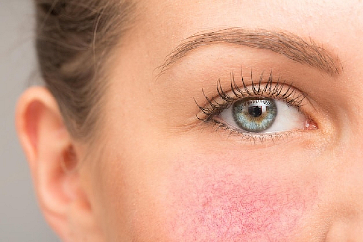 Rosacea Symptoms