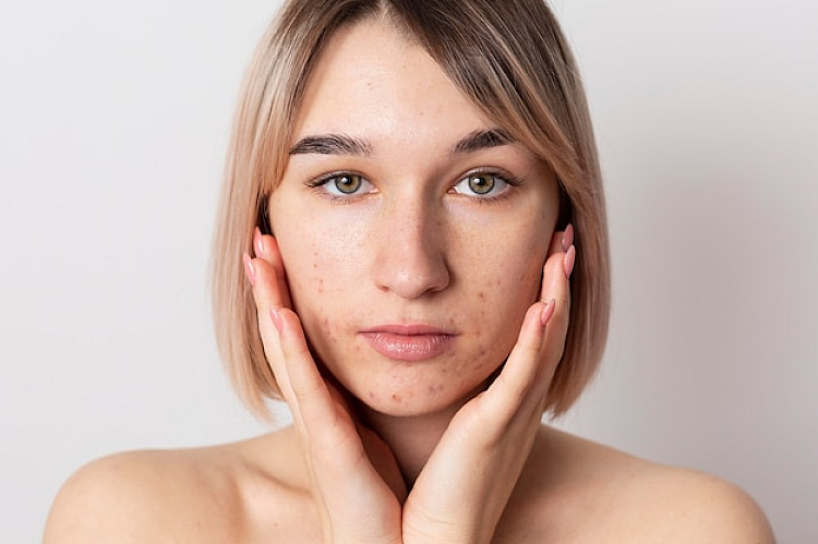 Melasma Symptoms
