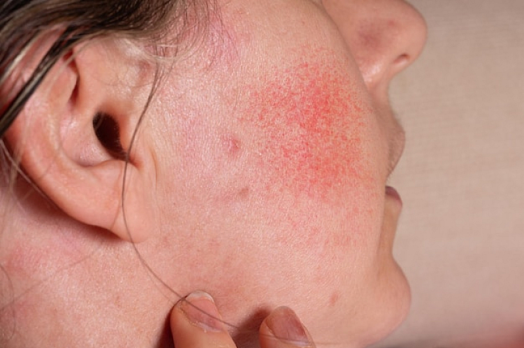 Rosacea Treatment