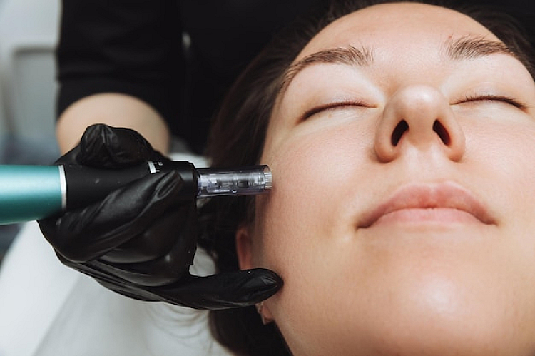 How Does Microneedling Work?