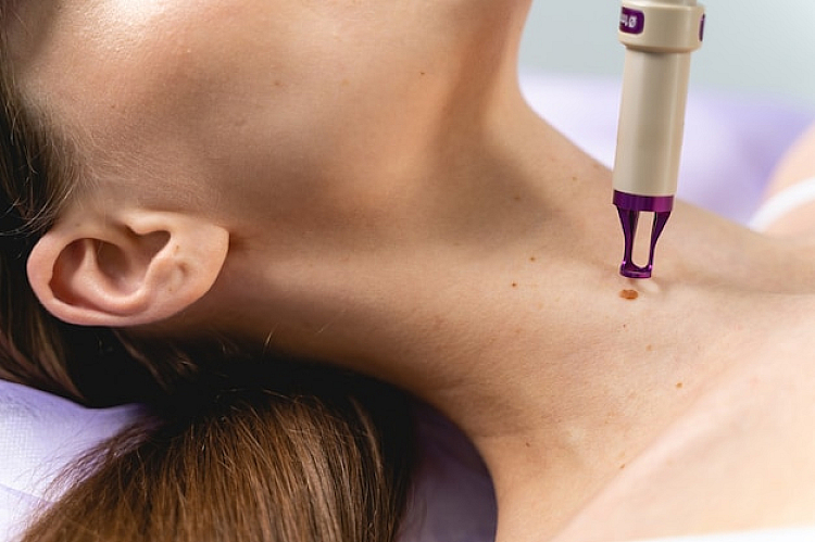 What causes moles?