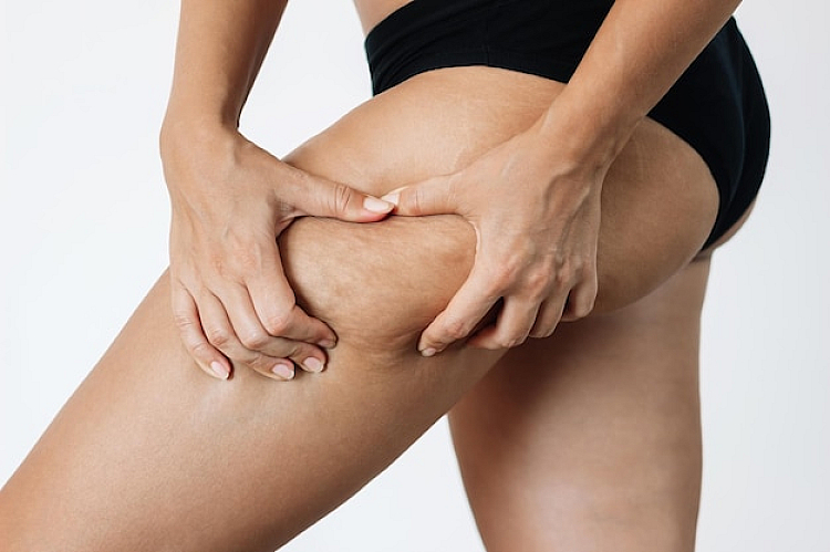 Why do women get more cellulite than men?