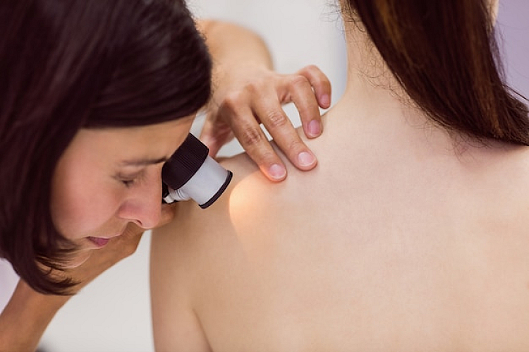 Benefits of Mole Removal