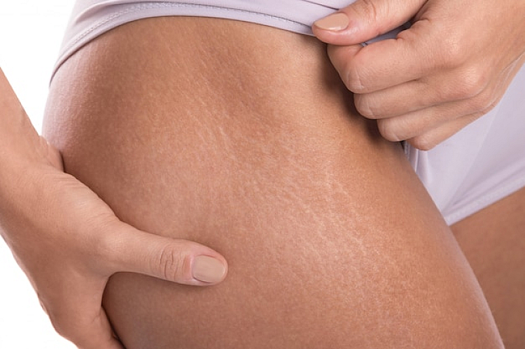Common Causes of Stretch Marks