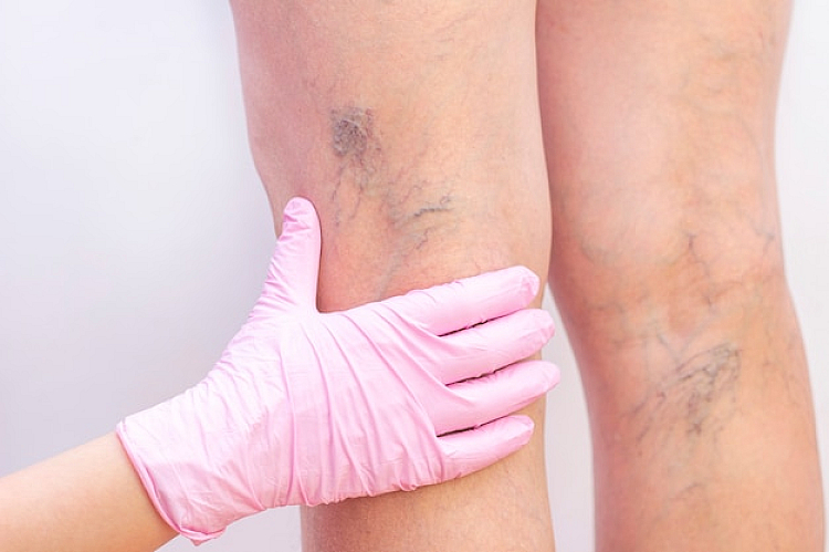 Benefits of Laser Spider Vein Treatment