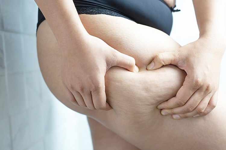 Areas that are affected by cellulite