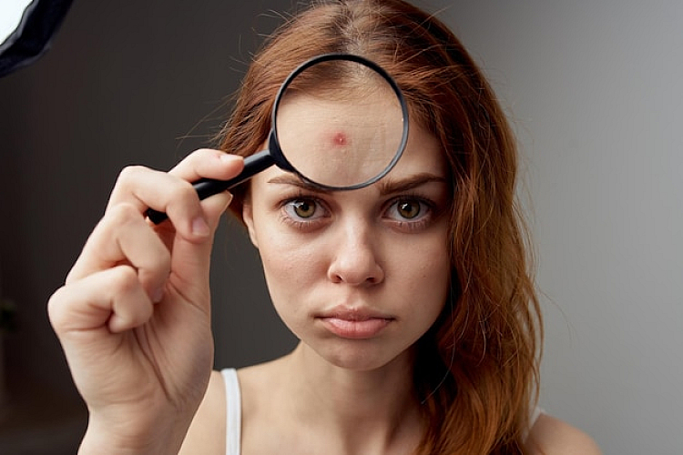 Who is a good candidate for an Acnelan® Treatment?