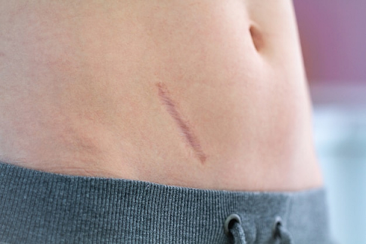 Laser Scar Removal Treatments