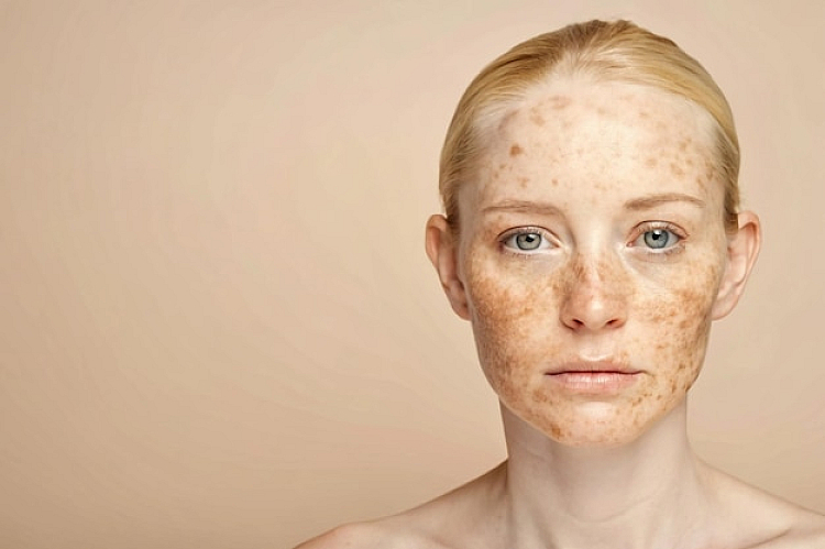 Melasma Treatment