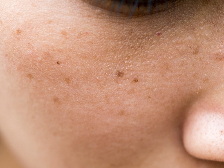Causes of Melasma
