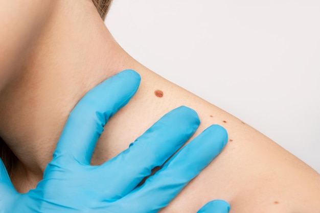 Types of Moles