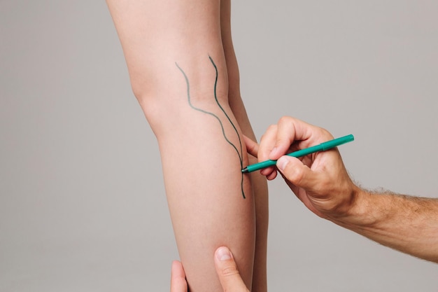 Laser Spider Vein Removal Treatment
