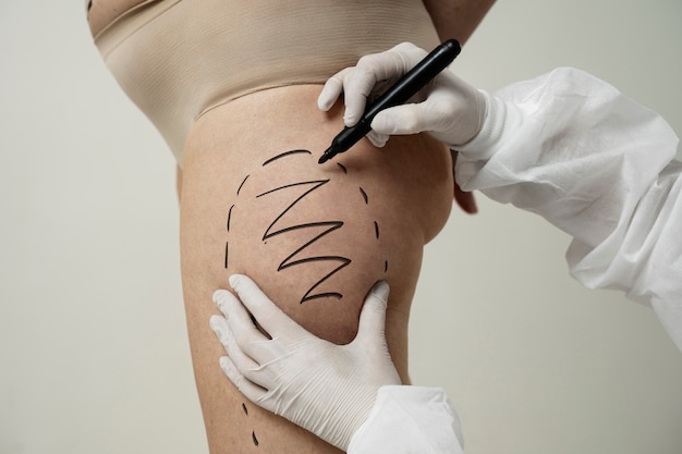 Fractional Laser Skin Resurfacing