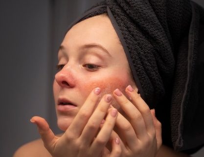 Rosacea Treatment in Toronto