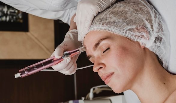 Micro Laser Peel