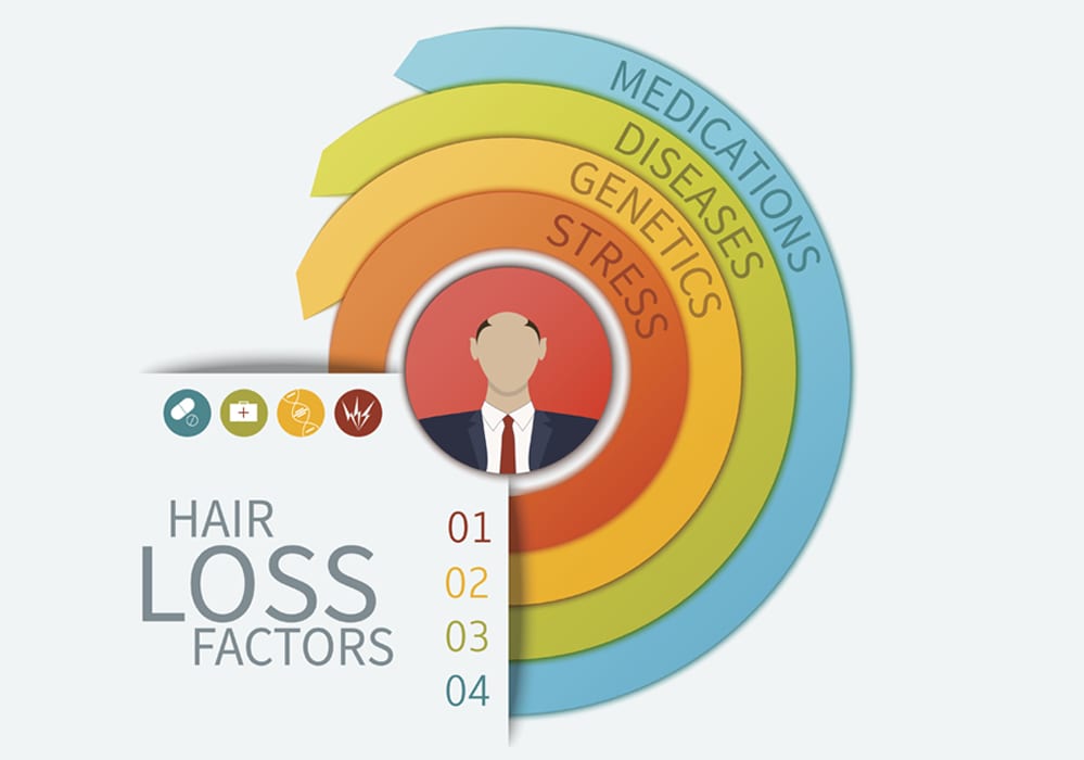 Male Pattern Hair Loss