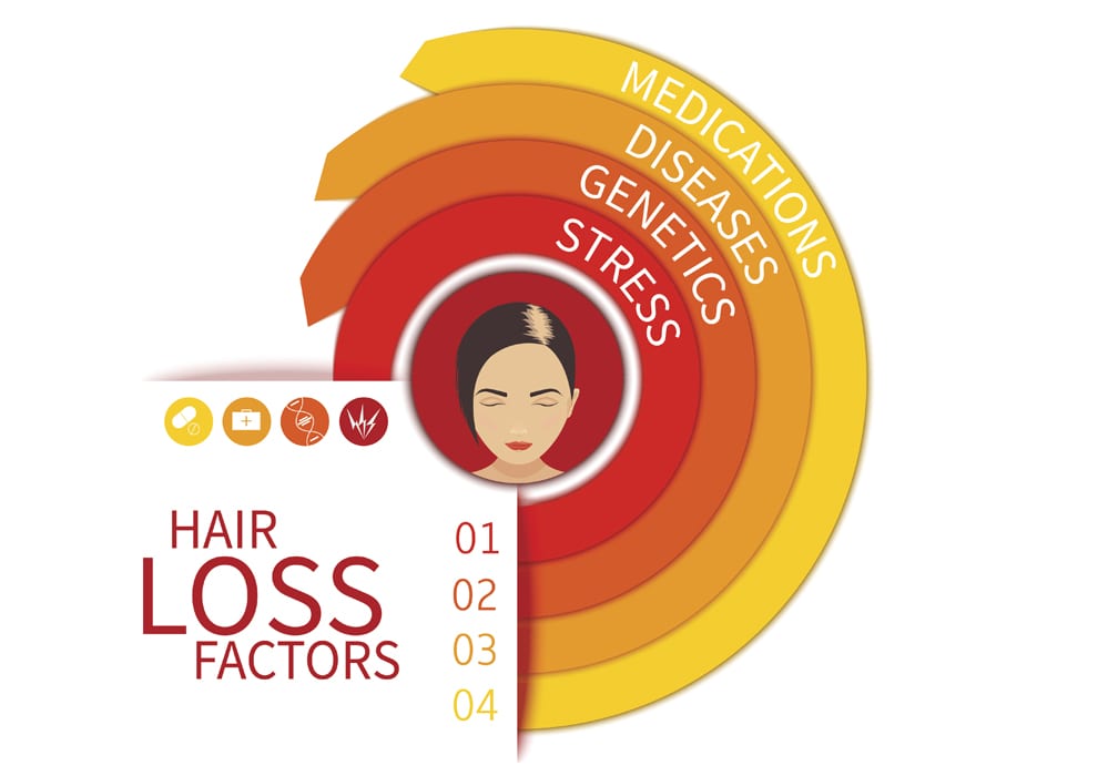 Female Pattern Hair Loss