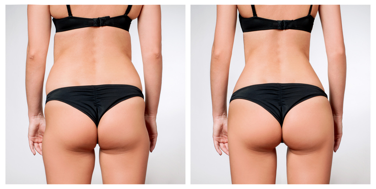 Benefits of a Non-Surgical BBL
