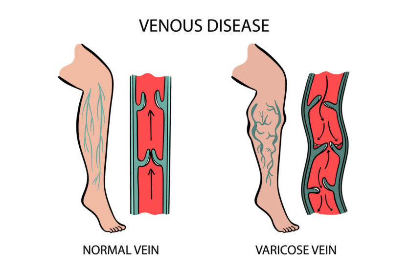 Benefits of VenaSeal™