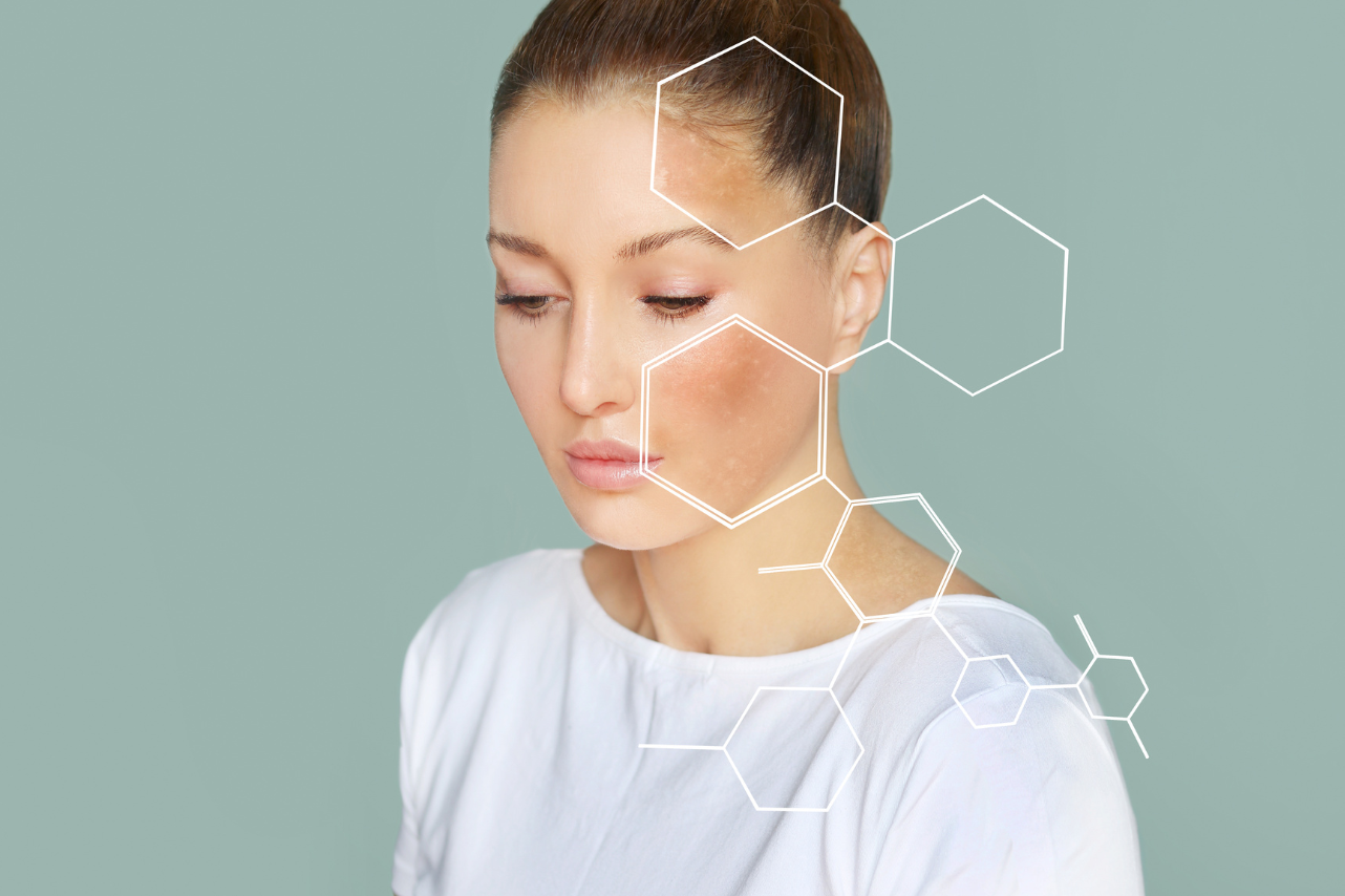 Acne Scars