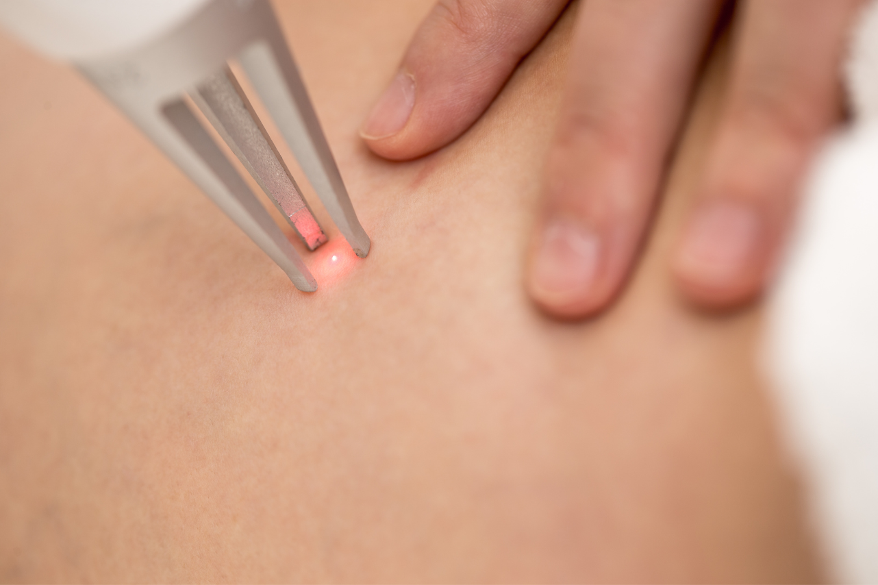 Causes of Spider Veins