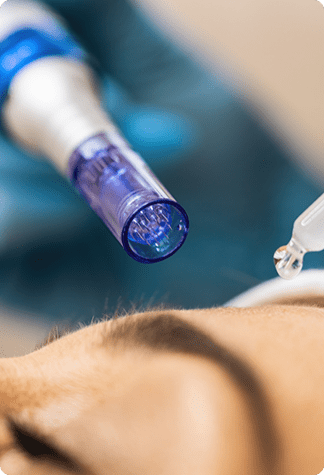 Microneedling