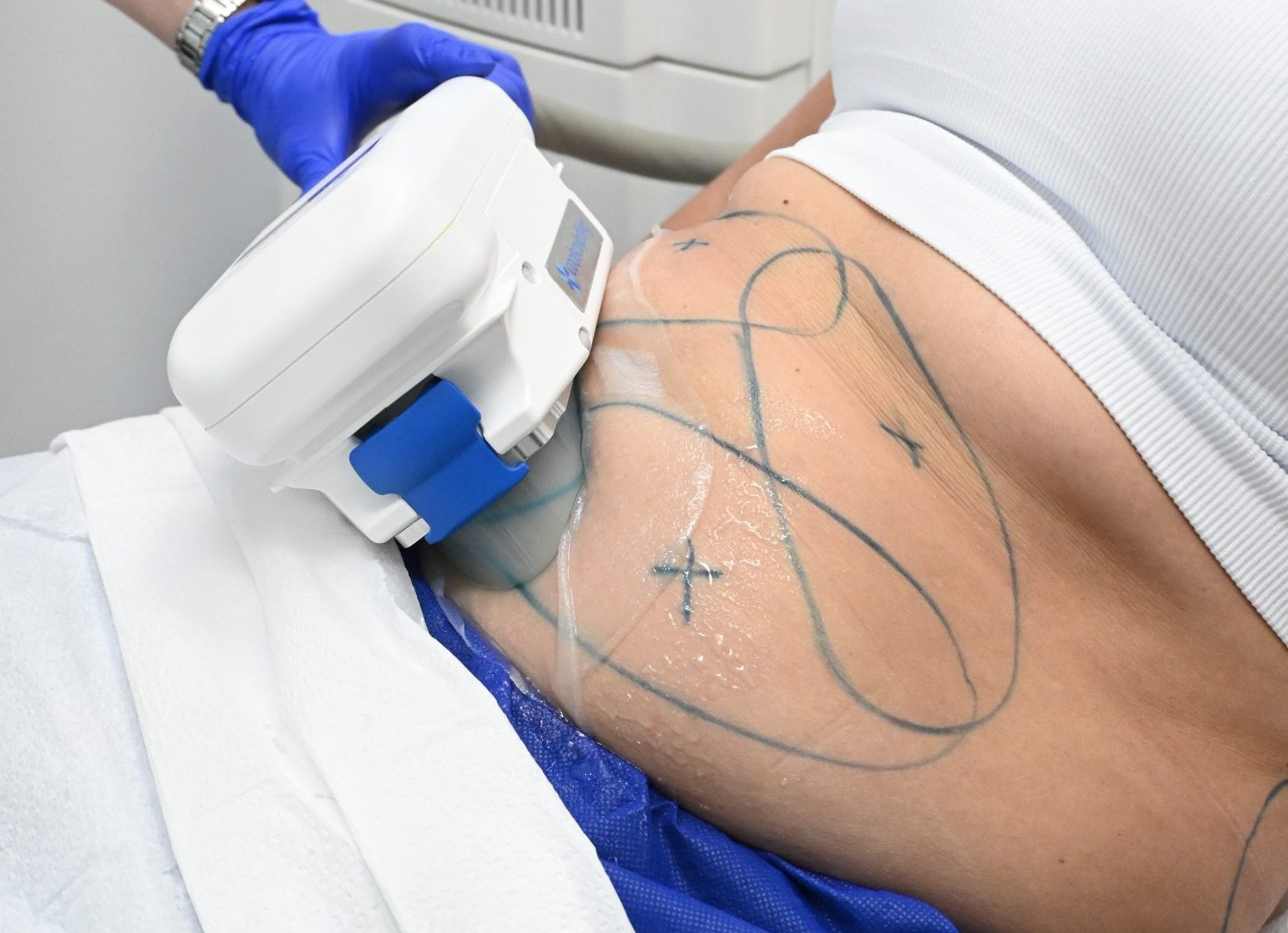 What Areas Can CoolSculpting Treat?