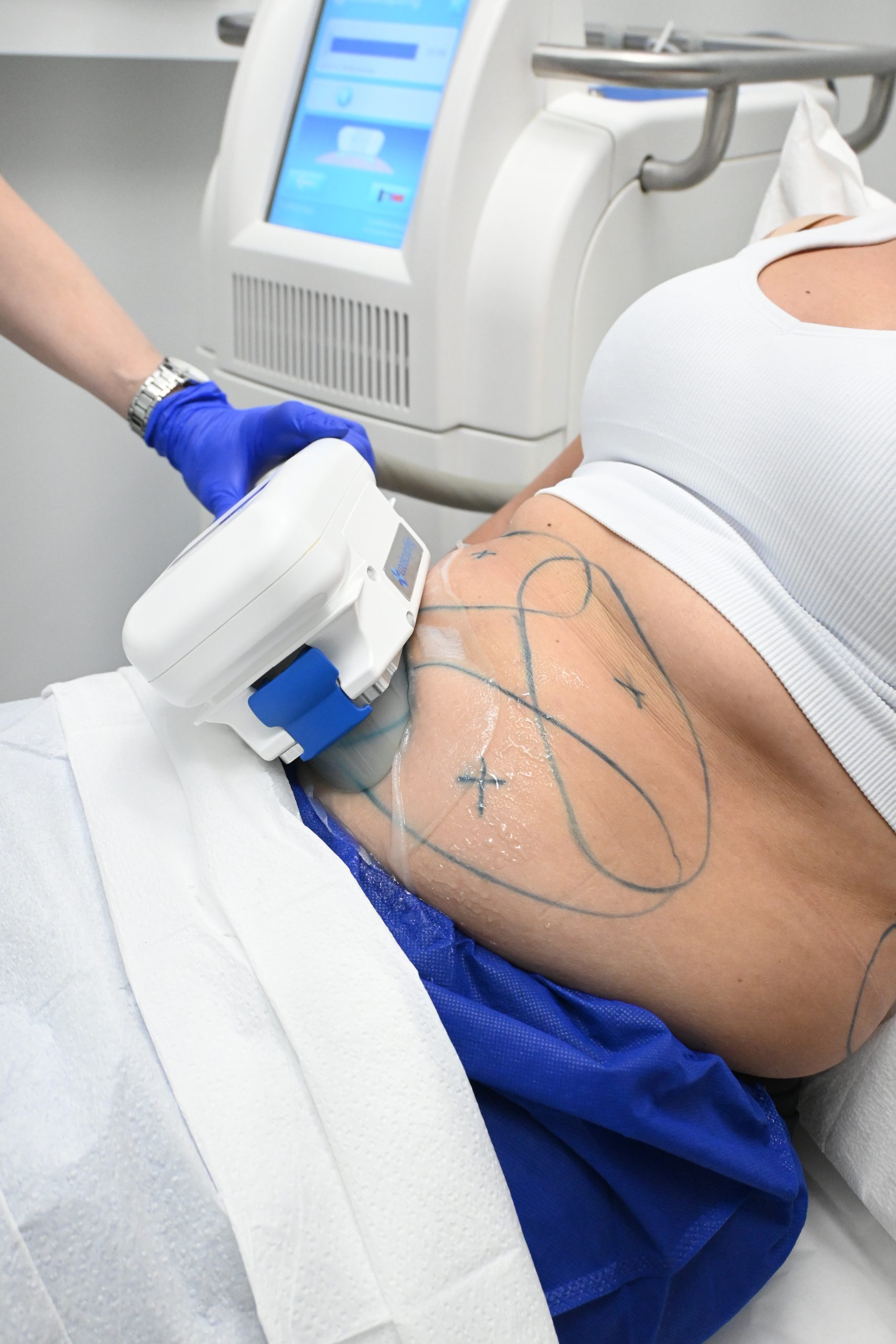 What Areas Can CoolSculpting Treat?