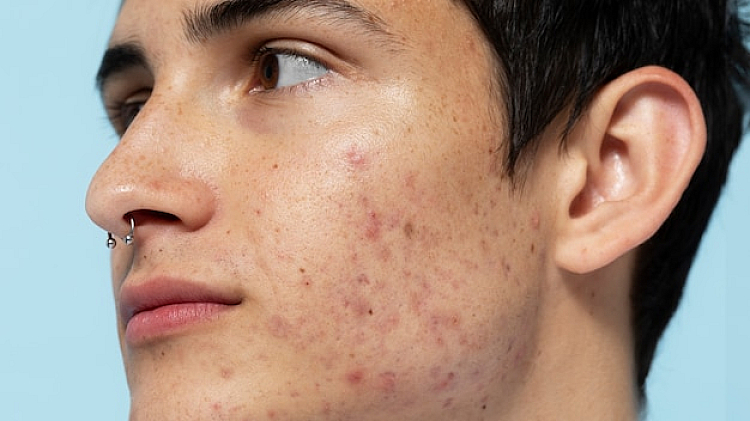 What Causes Acne?