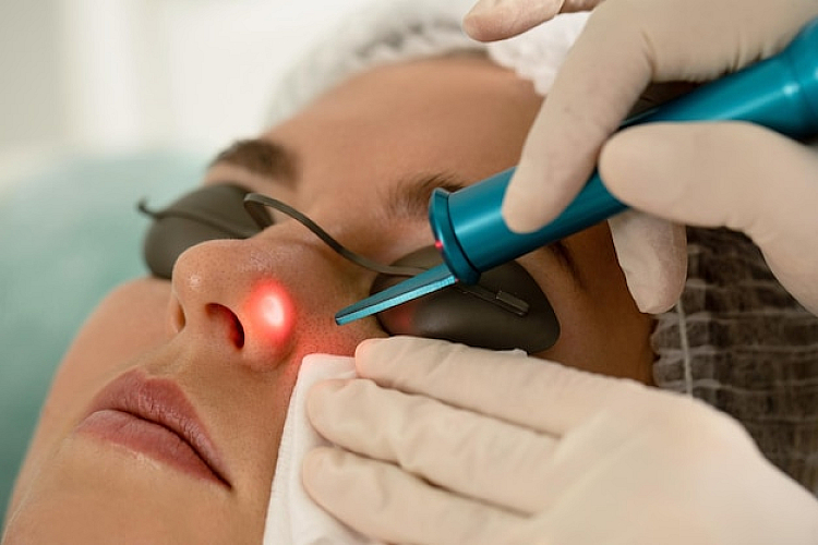2D Laser Acne Treatment – Dual Approach for Maximum Results