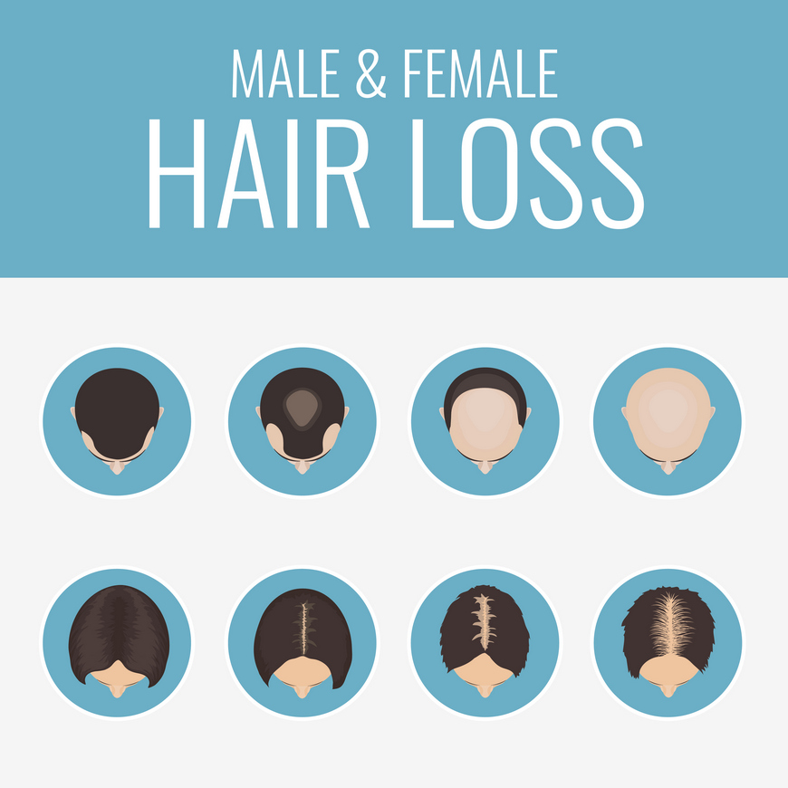 Hair Loss Treatments