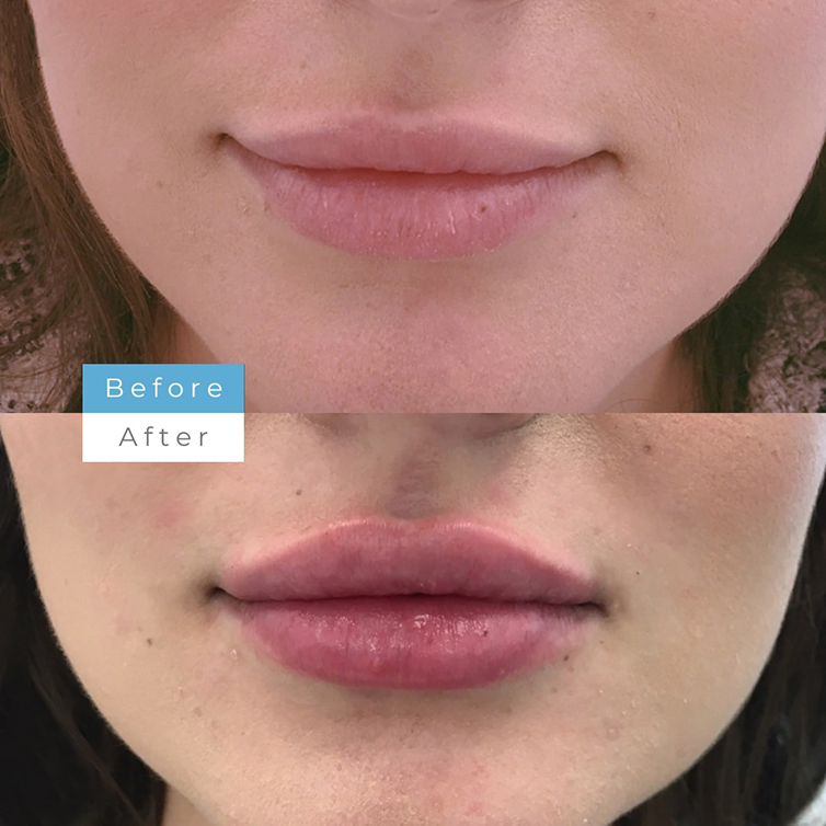 Nonsurgical Lip Augmentation